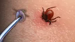 Sivas'ta KKKA Alarmı! 8 Kişiye Tanı, 1 Ölüm! Kene Tehlikesi!